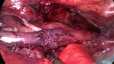 Exploration of the thoracoscopic treatment of esophageal atresia under high-frequency ventilation